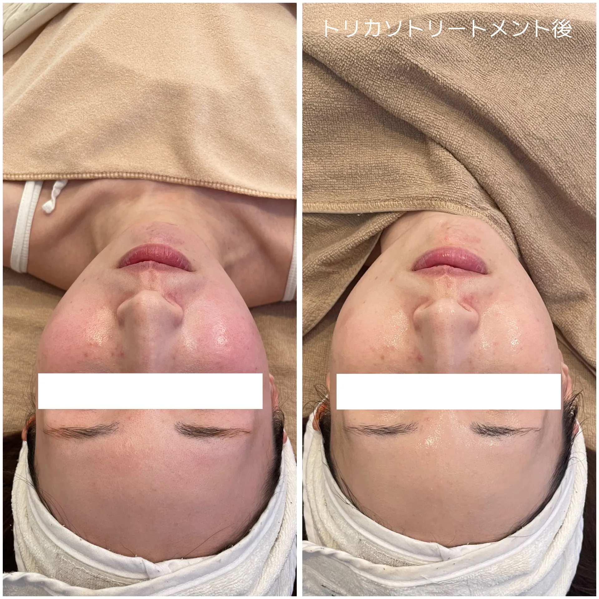 新メニュー人気です！トリカソ肌管理【BeforeAfter】三重県四日市市.／エステ