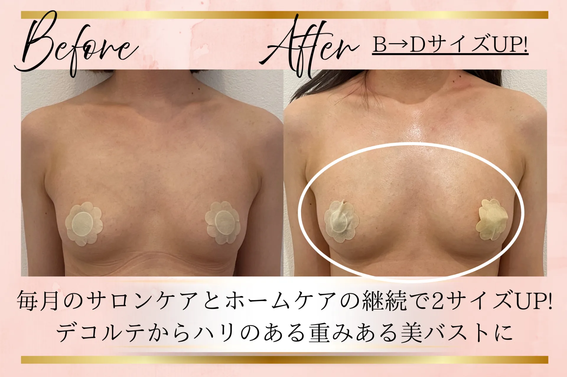 自家脂肪を増やしていく育乳【BeforeAfter】四日市／バストケア