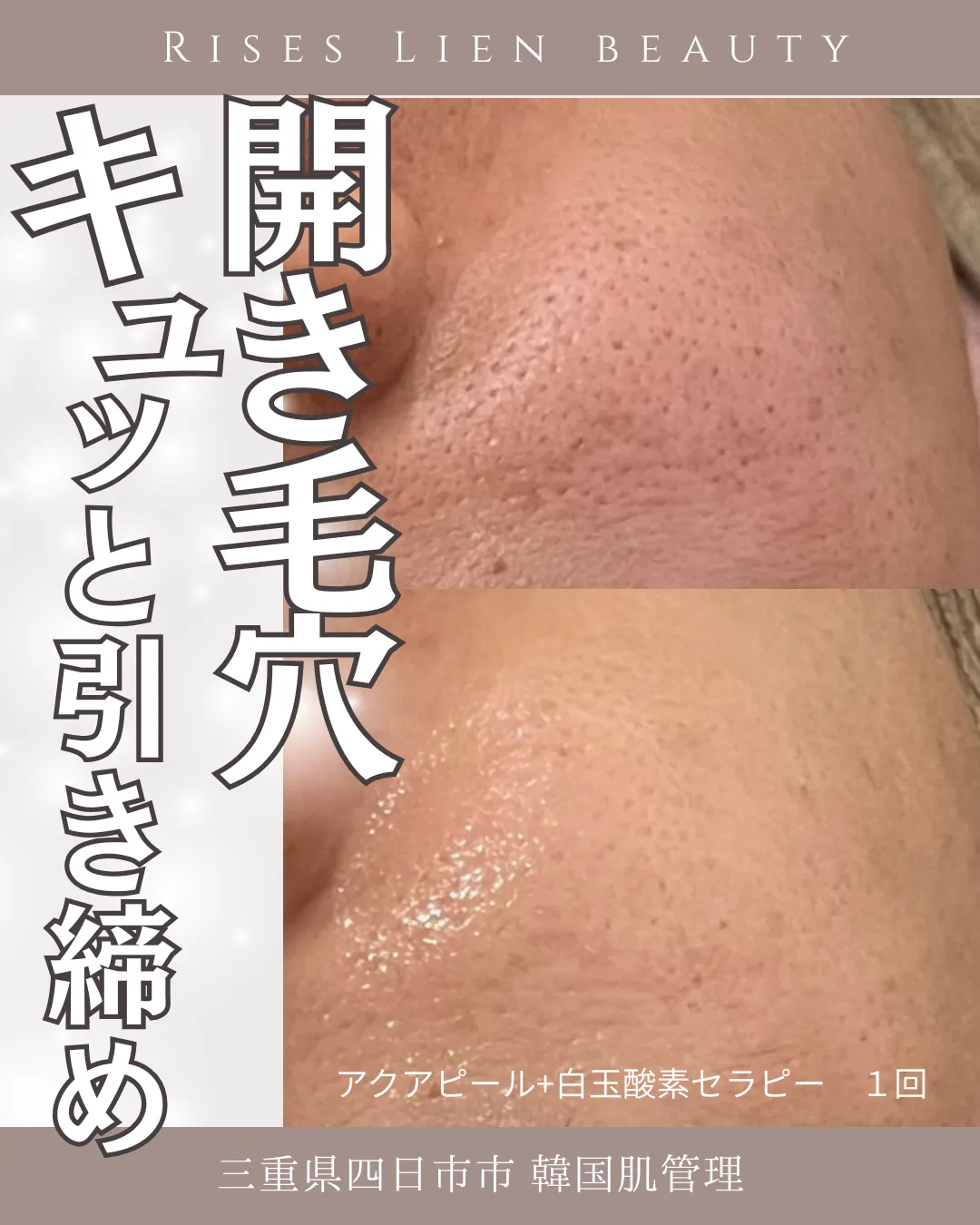 韓国肌管理【BeforeAfter】開き毛引き締め！三重県四日市市