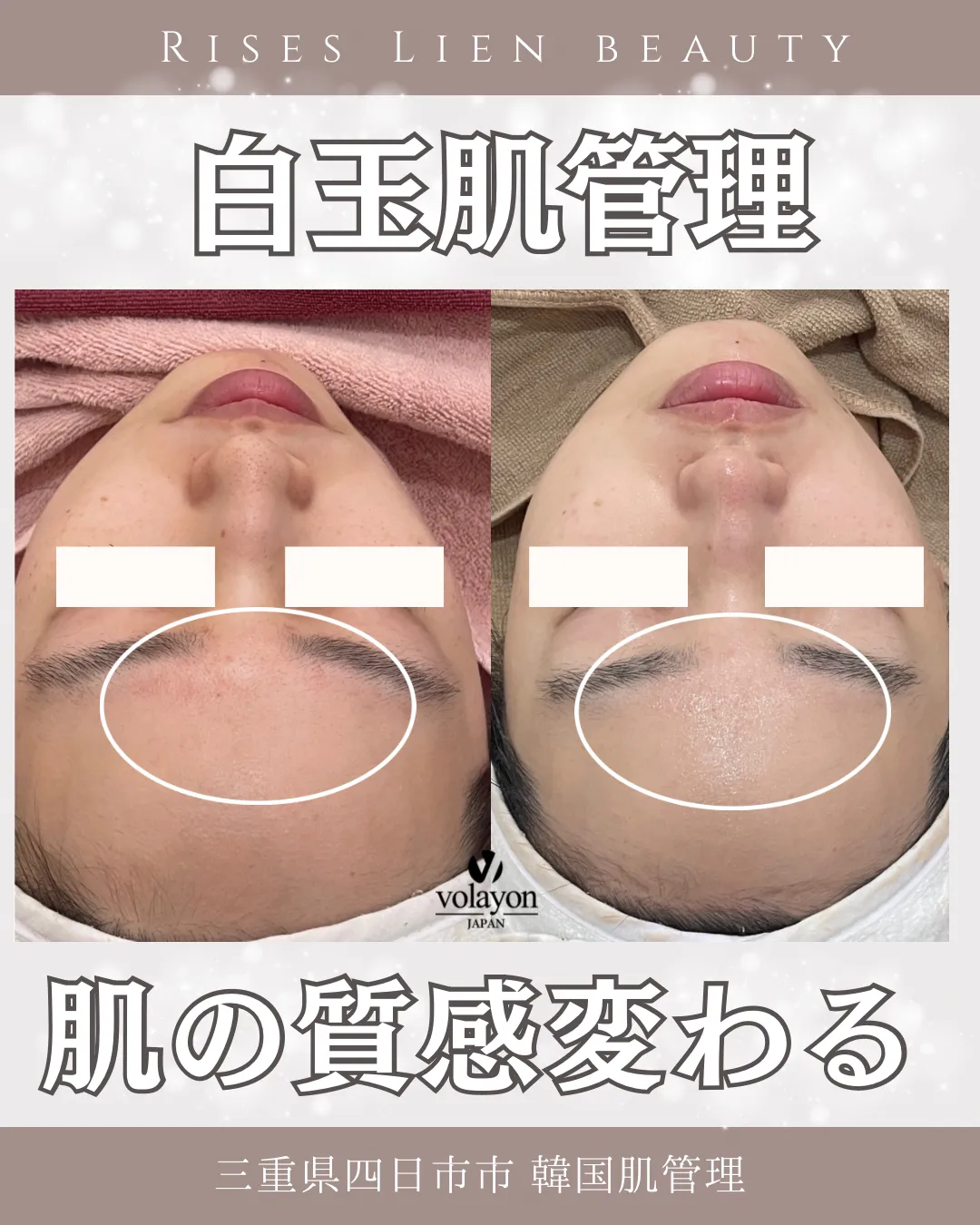 白玉肌管理【BeforeAfter】赤みレス圧倒的透明感！三重県四日市市