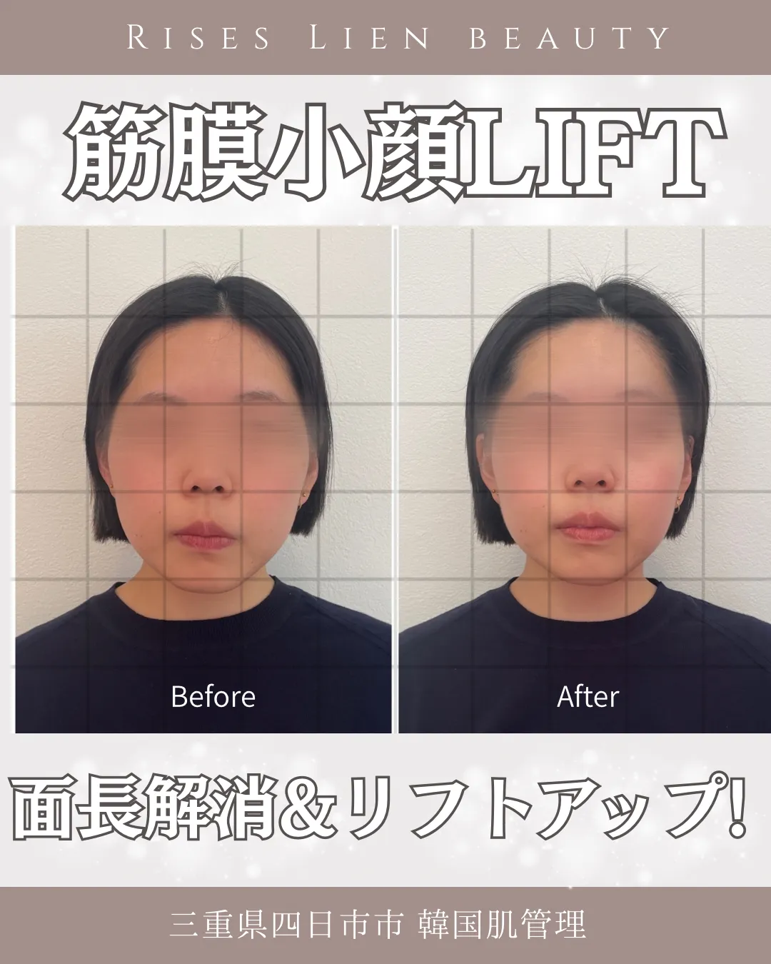 顔の余白なかったことに！魔法の小顔矯正【BeforeAfter】三重県四日市・小顔エステ